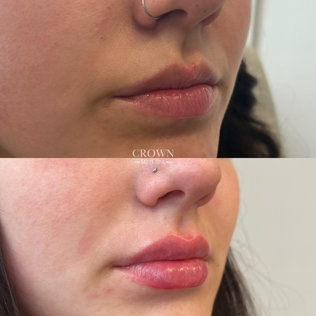 Lip Fillers Gallery Before & After