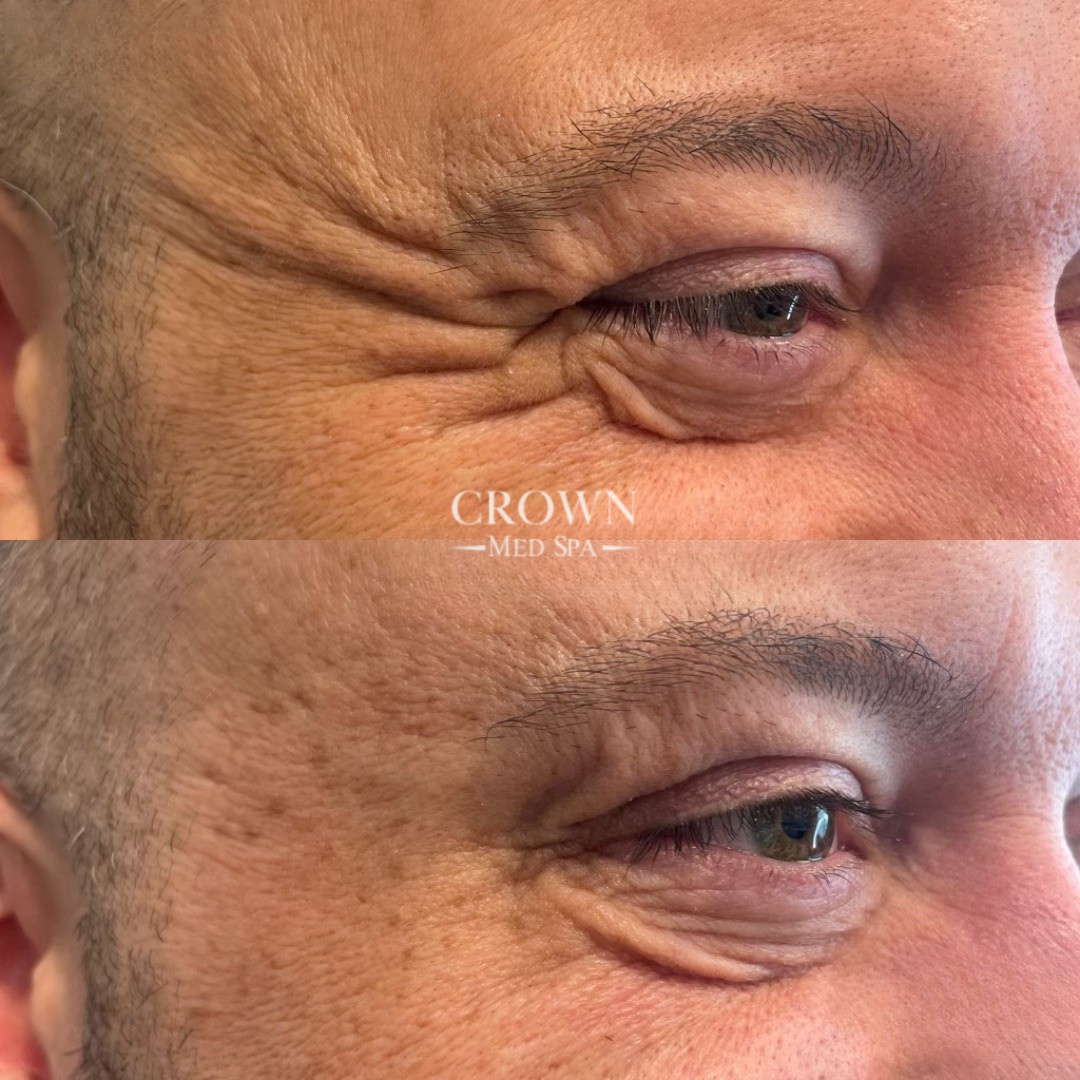 Botox Gallery Before & After